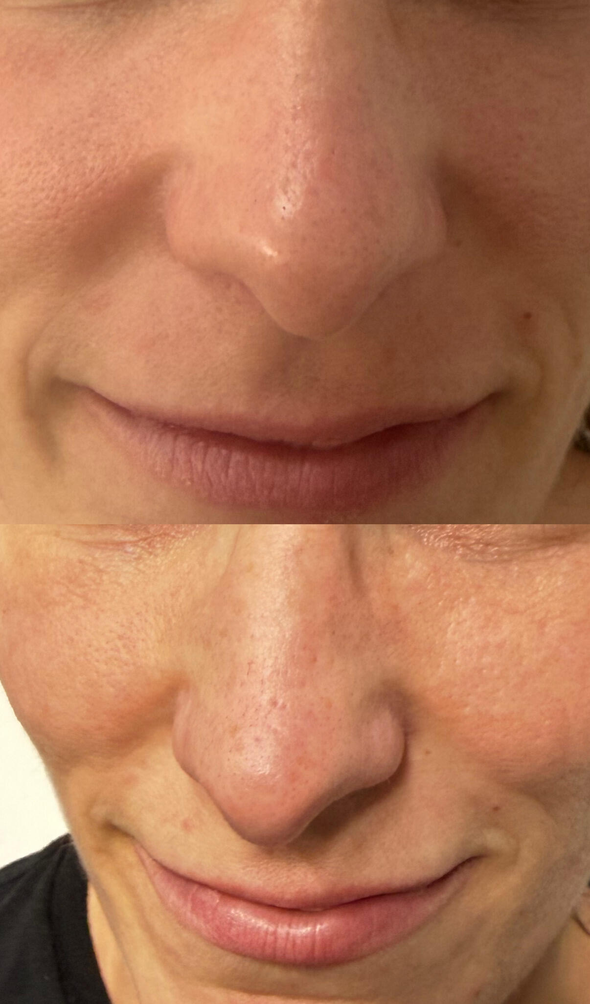 dermapen